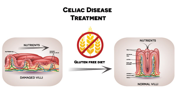 How The Body Heals After You Stop Eating Gluten